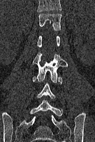 Normal CT lumbar spine (Radiopaedia 53981-60118 Coronal bone window 45).jpg