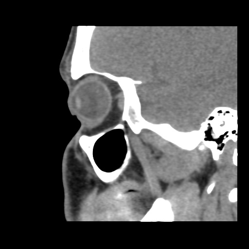 Normal CT paranasal sinuses (Radiopaedia 42286-45390 F 43).jpg