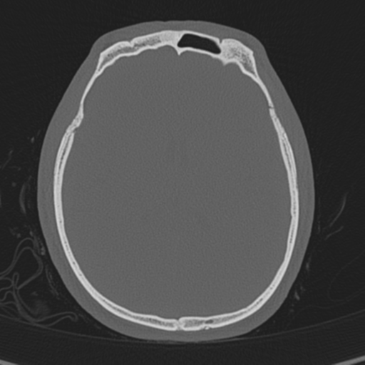 Normal CT skull (Radiopaedia 40798-43459 A 89).png