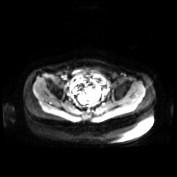 Normal MRI abdomen in pregnancy (Radiopaedia 88001-104541 Axial DWI 5).jpg
