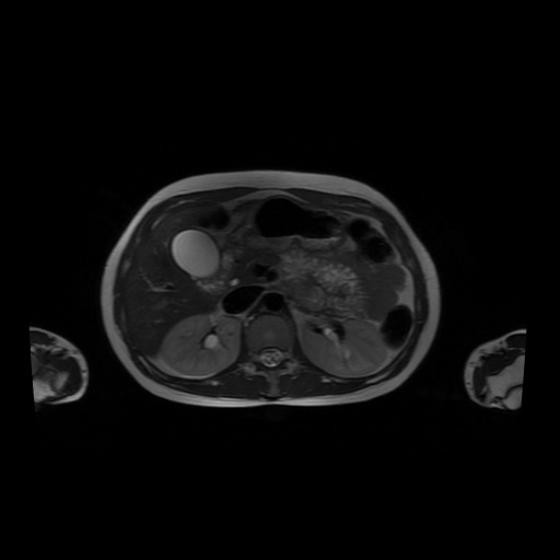 File:Normal MRI abdomen in pregnancy (Radiopaedia 88001-104541 Axial T2 19).jpg