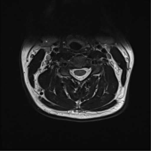 File:Normal MRI cervical spine (infection protocol) (Radiopaedia 53916-60039 Axial T2 24).png