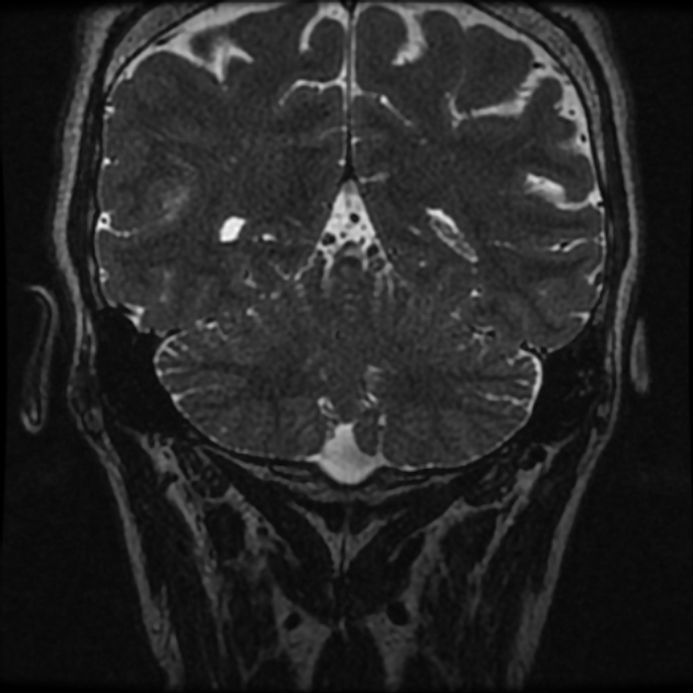 Normal MRI petrous (Radiopaedia 91317-108949 Coronal T2 108).jpg