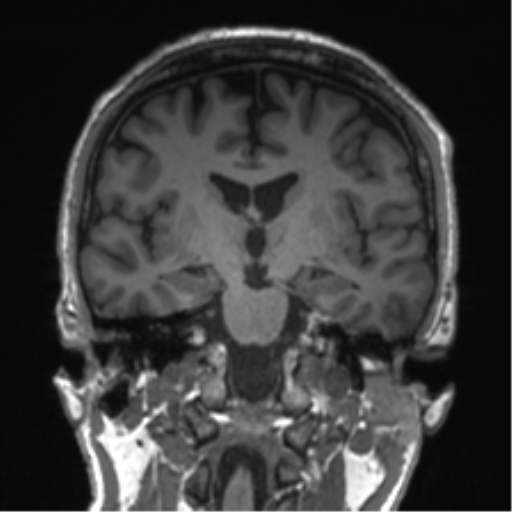 Normal brain MRI (non-focal epilepsy protocol) (Radiopaedia 53917-60040 Coronal T1 36).png