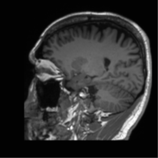 Normal brain MRI (non-focal epilepsy protocol) (Radiopaedia 53917-60040 Sagittal T1 22).png