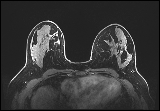 Normal breast MRI - dense breasts (Radiopaedia 80454-93850 C 105).jpg