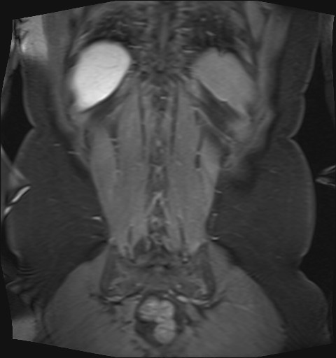 File:Normal hepatobiliary phase liver MRI (Radiopaedia 58968-66230 B 5).jpg