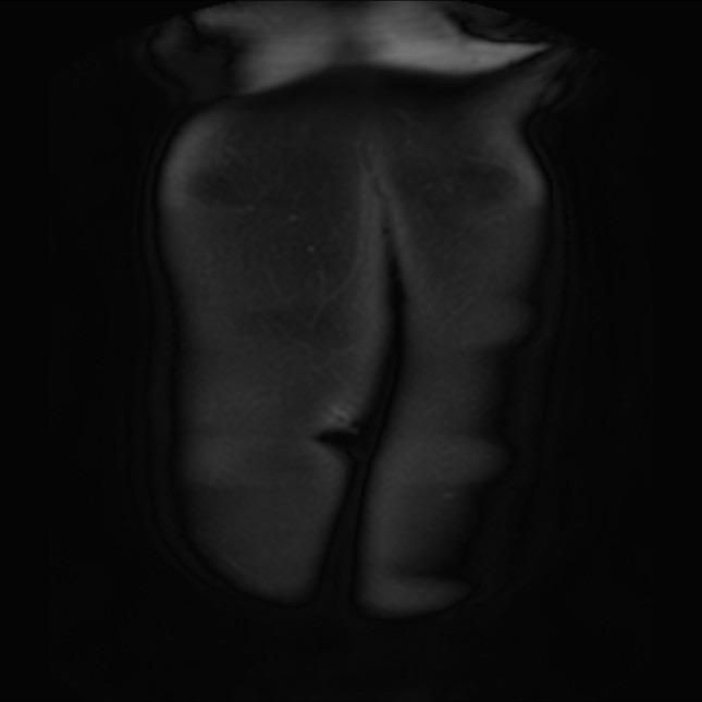 Normal liver MRI with Gadolinium (Radiopaedia 58913-66163 P 1).jpg