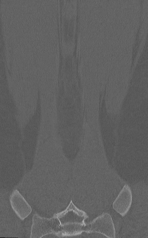 Normal lumbar spine CT (Radiopaedia 46533-50986 Coronal bone window 75).png