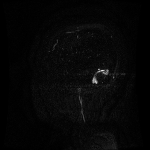 Normal noncontrast MR venography (Radiopaedia 87578-103957 A 22).jpg