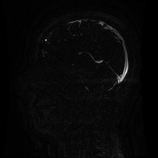 Normal noncontrast MR venography (Radiopaedia 87578-103957 A 90).jpg