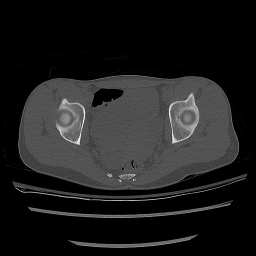 Normal pelvis CT (Radiopaedia 51471-57236 Axial bone window 64).jpg
