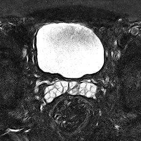 File:Normal prostate (MRI) (Radiopaedia 29986-30535 Axial STIR 18).jpg