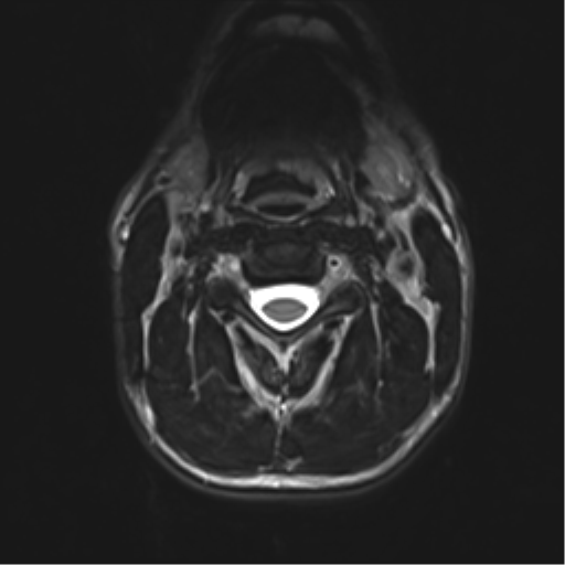 Normal trauma cervical spine (Radiopaedia 41017-43762 D 15).png