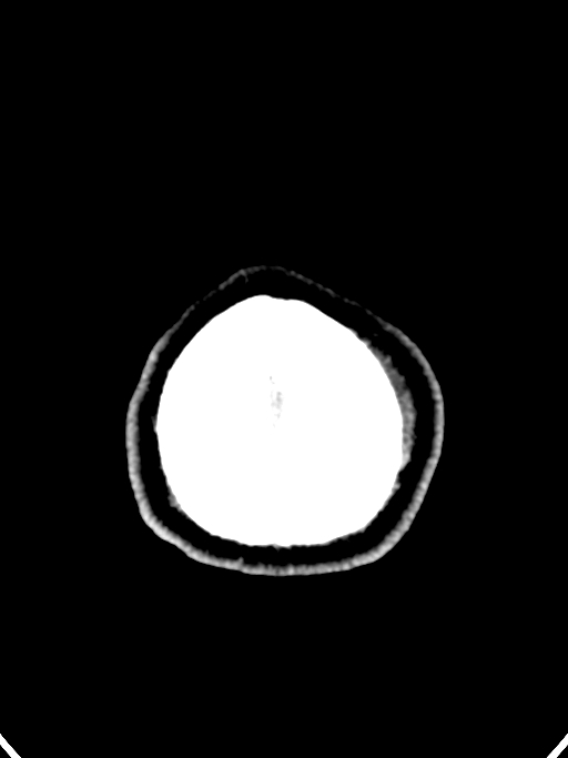 Normal trauma protocol brain and C-spine CT (Radiopaedia 83302-97709 Axial non-contrast 8).jpg
