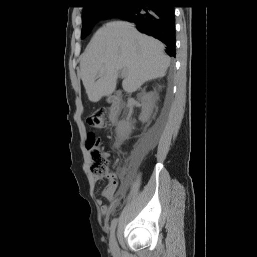 File:Obstructed kidney with perinephric urinoma (Radiopaedia 26889-27066 B 13).jpg