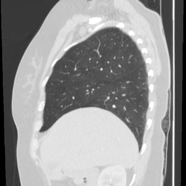 Obstructing typical carcinoid causing bronchoceles (Radiopaedia 50149-55476 Sagittal lung window 15).png