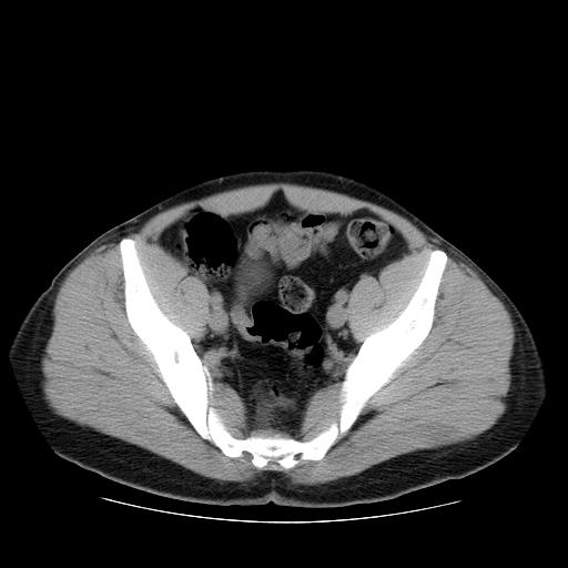File:Obstructing ureteric calculus (Radiopaedia 18615-18514 Axial non-contrast 46).jpg