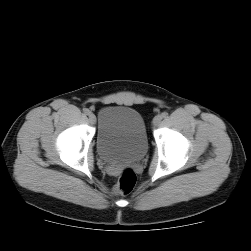 File:Obstructing ureteric calculus (Radiopaedia 18615-18514 Axial non-contrast 52).jpg