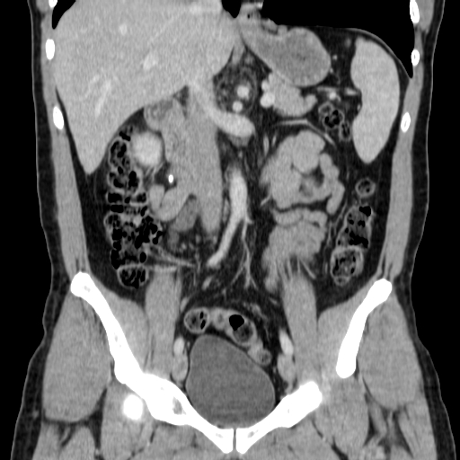 File:Obstructing ureteric calculus (Radiopaedia 18615-18514 C 37).jpg