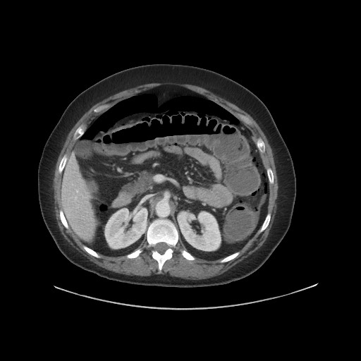 Obstructive distal colonic adenocarcinoma causing cecal perforation (Radiopaedia 86830-102989 A 72).jpg