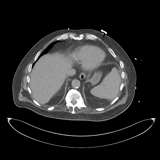 File:Obstructive pyelonephritis (Radiopaedia 46411-50844 Axial non-contrast 14).png