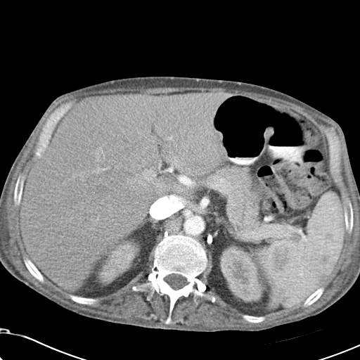 File:Obstructive superior vena cava tumor thrombus (Radiopaedia 28046-28306 A 57).jpg