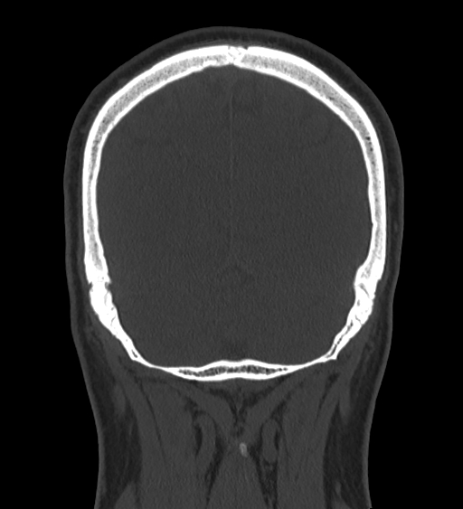 Occipital spur and Currarino type A atlas anomaly (Radiopaedia 87027-103285 Coronal bone window 117).jpg