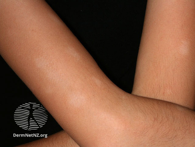 File:Pityriasis alba (DermNet NZ dermatitis-s-pityriasis-alba-1).jpg