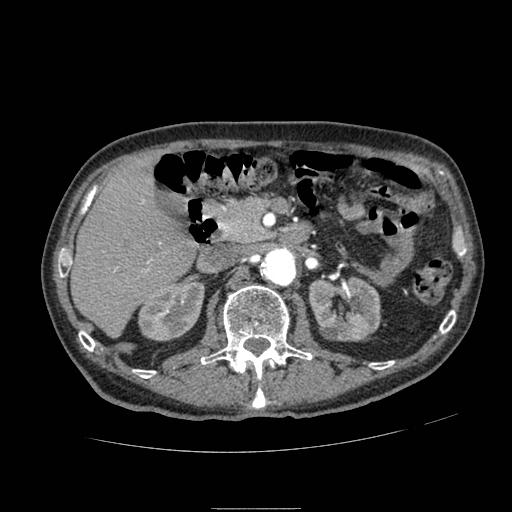Abdominal aortic aneurysm (Radiopaedia 13341-13340 Axial C+ arterial phase 68).jpg