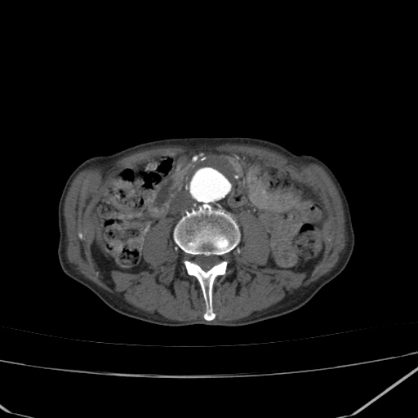 Abdominal aortic aneurysm (Radiopaedia 23703-23856 Axial C+ arterial phase 43).jpg