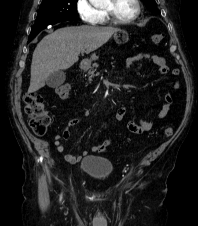 Abdominal aortic aneurysm (Radiopaedia 25855-26001 Coronal C+ arterial phase 10).jpg