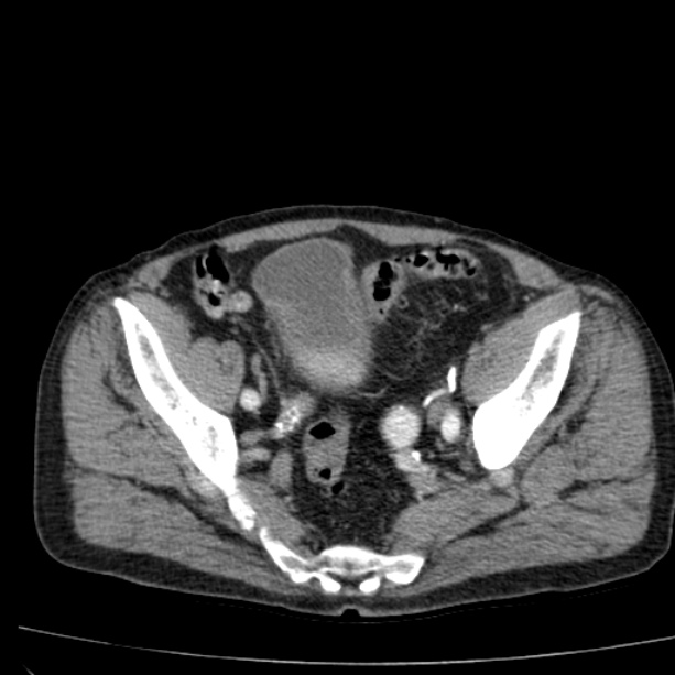 Abdominal aortic aneurysm (Radiopaedia 29248-29660 Axial C+ arterial phase 74).jpg