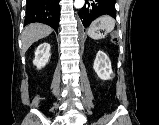 Abdominal aortic aneurysm (Radiopaedia 67117-76452 Coronal C+ arterial phase 80).jpg