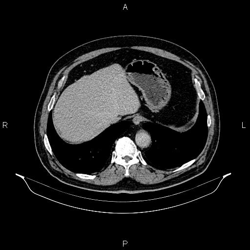 File:Abdominal aortic aneurysm (Radiopaedia 83094-97462 Axial renal excretory phase 19).jpg