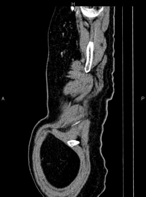 Abdominal aortic aneurysm (Radiopaedia 83094-97462 Sagittal renal cortical phase 9).jpg