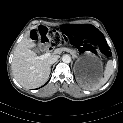 Abdominal aortic aneurysm (Radiopaedia 83581-98689 Axial C+ portal venous phase 27).jpg