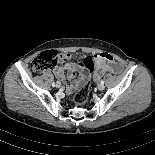 Abdominal aortic aneurysm (Radiopaedia 83581-98689 Axial C+ portal venous phase 90).jpg