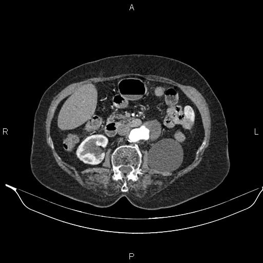 File:Abdominal aortic aneurysm (Radiopaedia 85063-100606 Axial C+ arterial phase 38).jpg