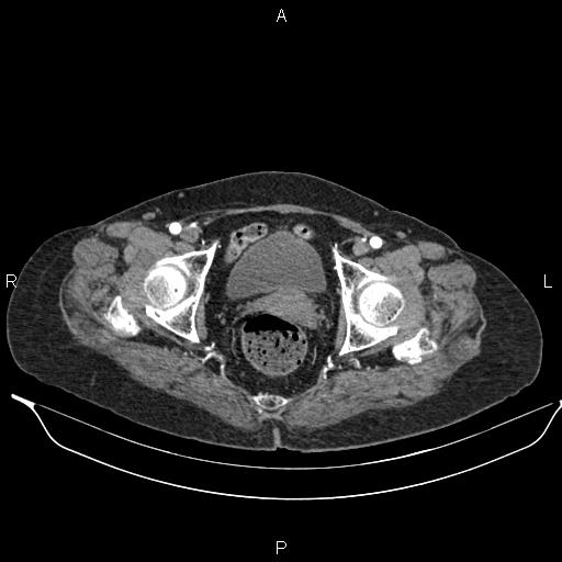File:Abdominal aortic aneurysm (Radiopaedia 85063-100606 Axial C+ arterial phase 62).jpg