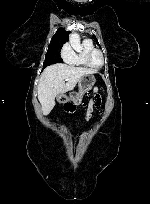 Abdominal aortic aneurysm (Radiopaedia 85063-100606 Coronal C+ arterial phase 8).jpg