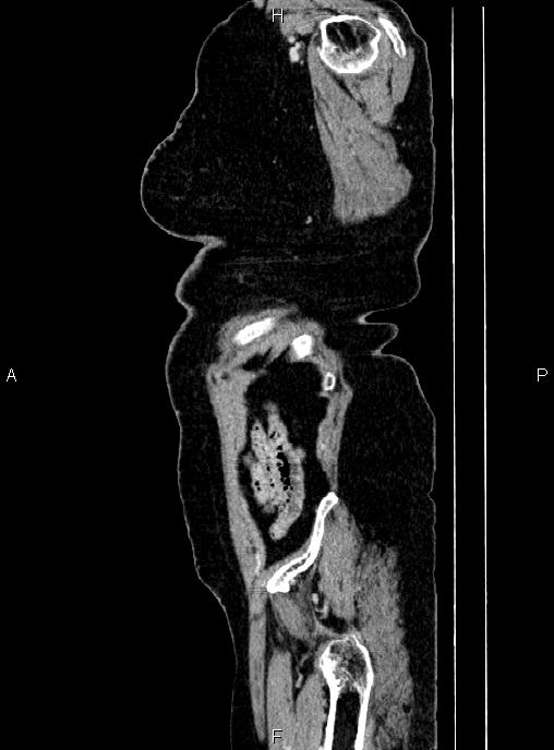 Abdominal aortic aneurysm (Radiopaedia 85063-100606 Sagittal C+ arterial phase 79).jpg