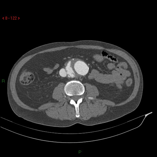 Abdominal aortic aneurysm rupture with aortocaval fistula (Radiopaedia 14897-14841 Axial C+ arterial phase 122).jpg
