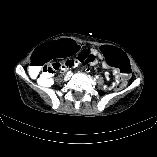 File:Abdominal collection due to previous cecal perforation (Radiopaedia 80831-94320 Axial C+ portal venous phase 137).jpg