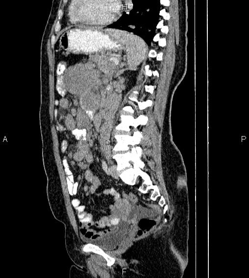 Abdominal lymphoma with sandwich sign (Radiopaedia 84378-99704 Sagittal C+ portal venous phase 55).jpg