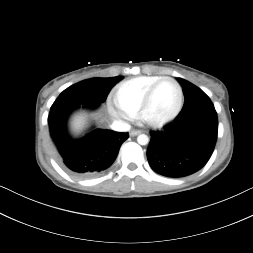 Abdominal multi-trauma - devascularised kidney and liver, spleen and pancreatic lacerations (Radiopaedia 34984-36486 Axial C+ portal venous phase 5).png