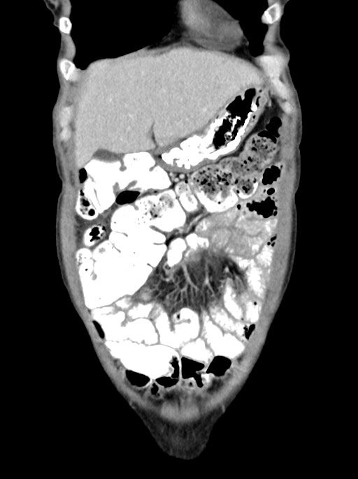 Abdominal wall and retroperitoneal tuberculosis (Radiopaedia 88137-104729 Coronal C+ portal venous phase 22).jpg
