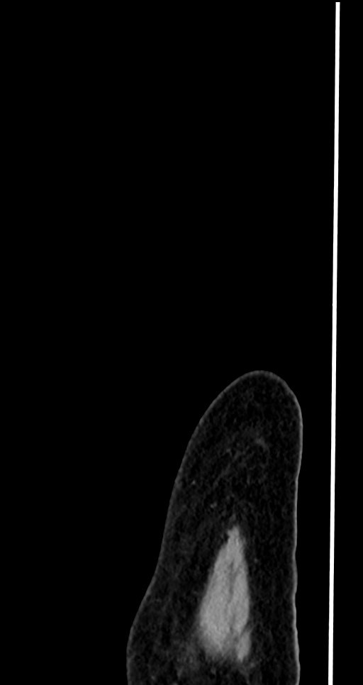 Abdominal wall and retroperitoneal tuberculosis (Radiopaedia 88137-104729 Sagittal C+ portal venous phase 5).jpg