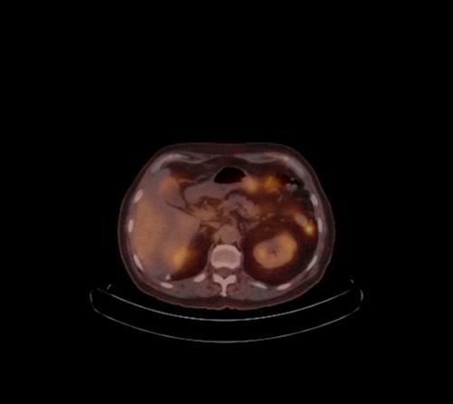 Abdominal wall metastasis from colorectal carcinoma (Radiopaedia 31016-31719 C 79).jpg