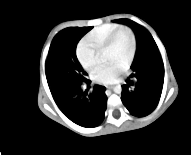 Abdominopelvic rhabdomyosarcoma (Radiopaedia 78356-90984 Axial C+ portal venous phase 25).jpg